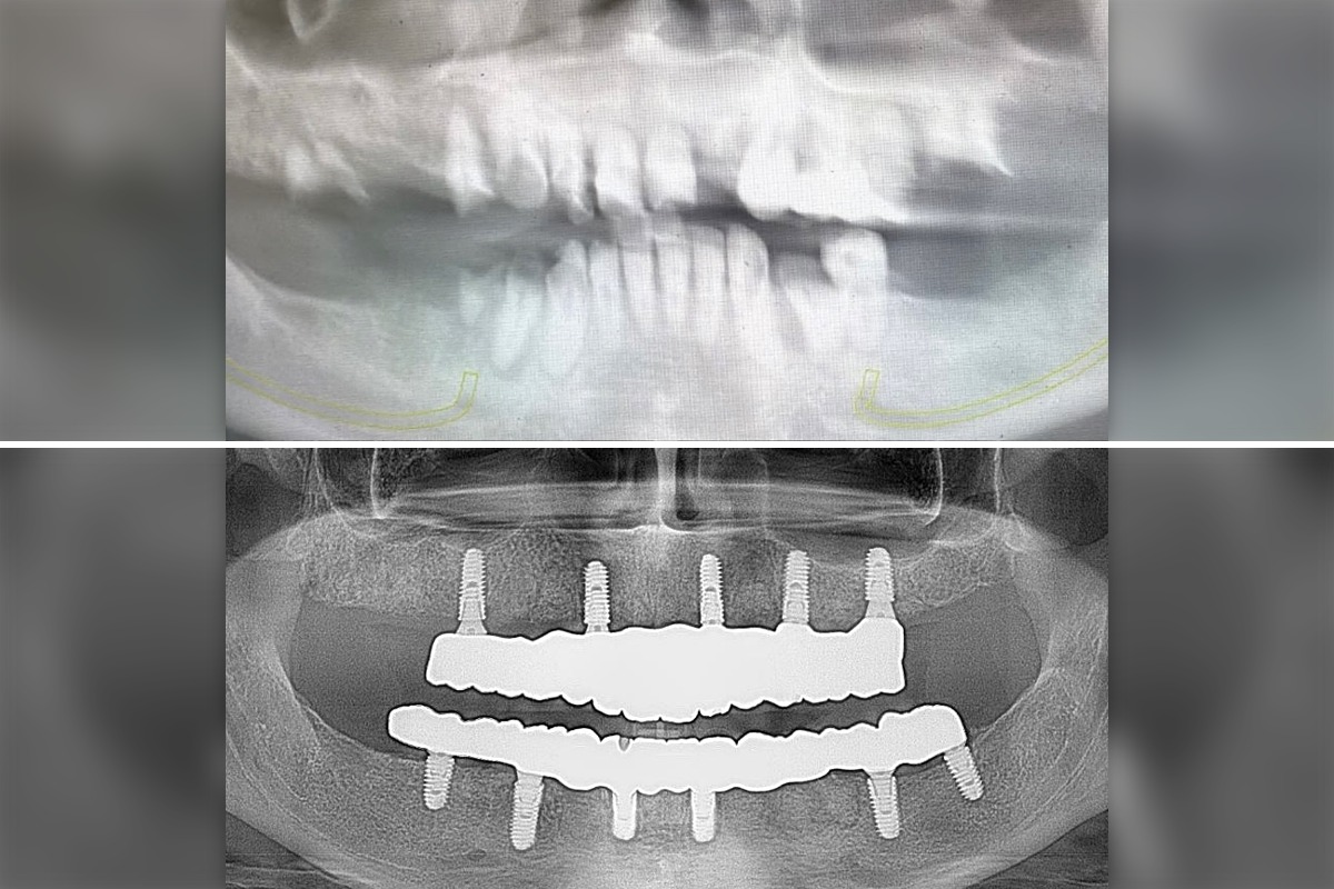 Before and after panoramic X-ray of an All-on-6 zirconia restoration on both arches