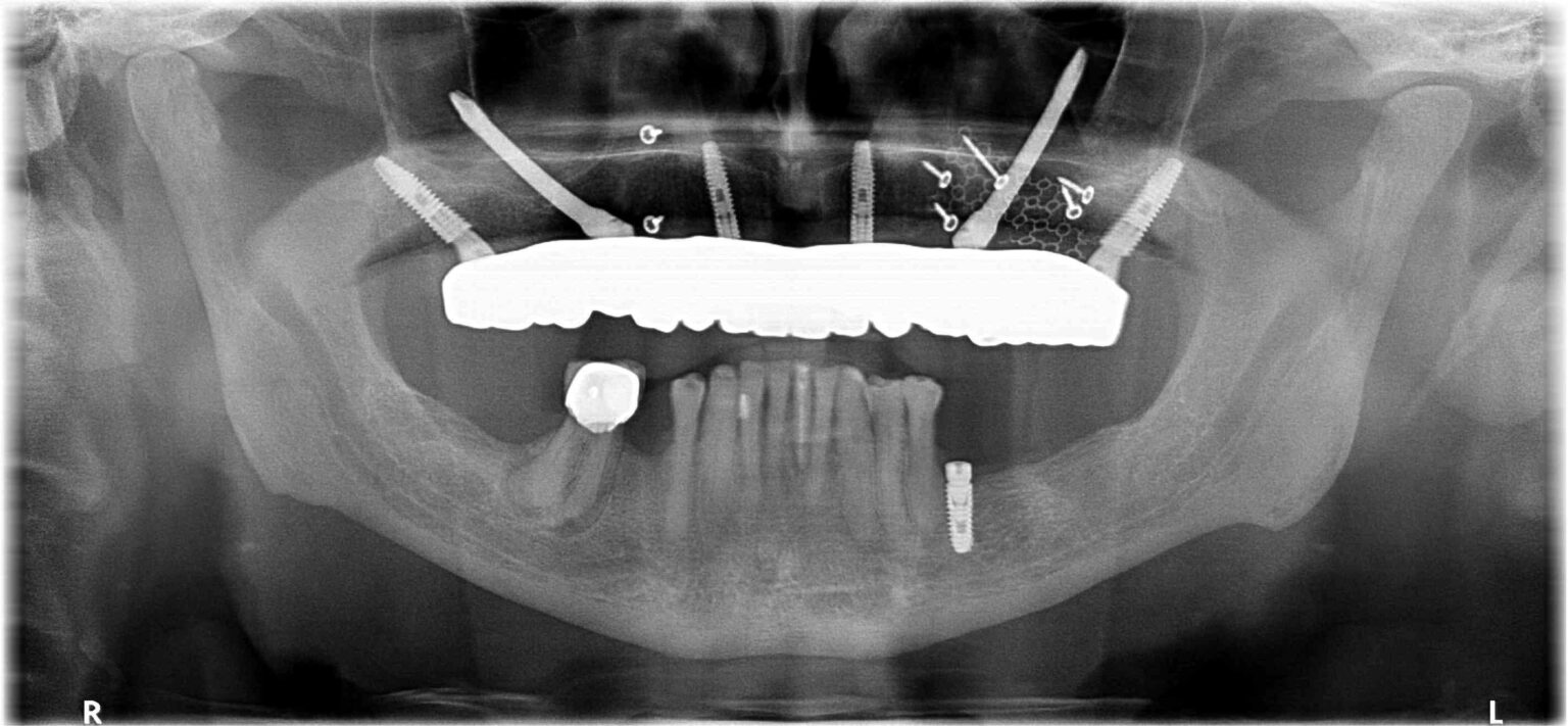 Panoramic X-ray showing zygomatic, transnasal and pterygoid implants supporting an upper full-arch prosthesis