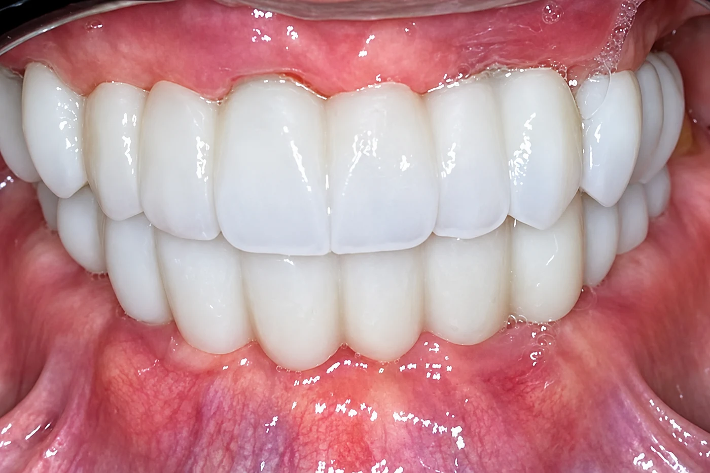 Full-arch zirconia restoration