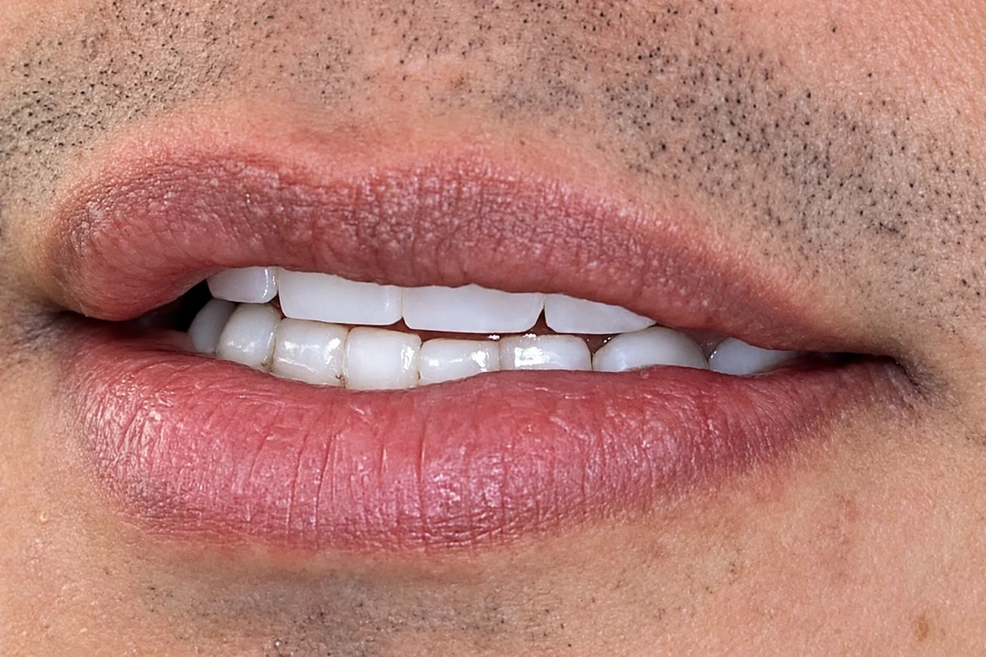 Natural-looking white smile with zirconia crowns