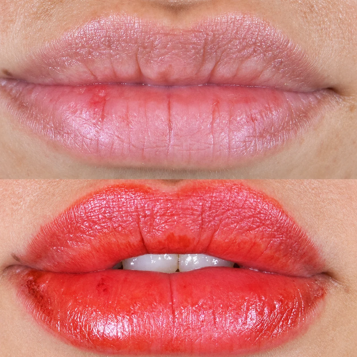 Before and after lip enhancement with hyaluronic acid filler