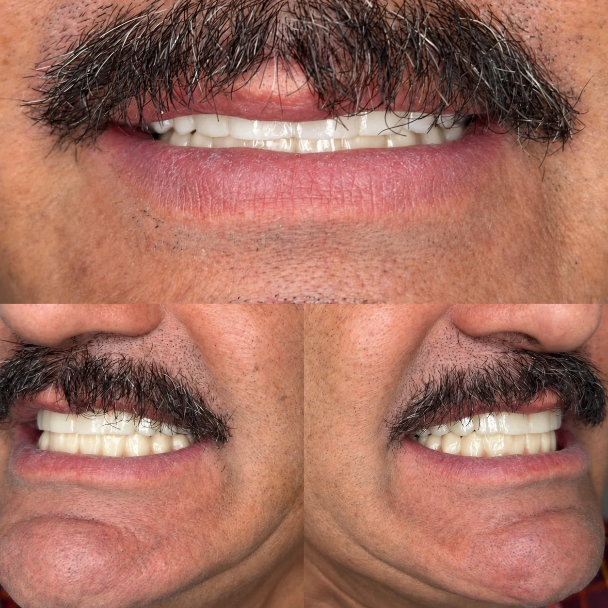 Frontal and side views of a smile beneath a dark moustache