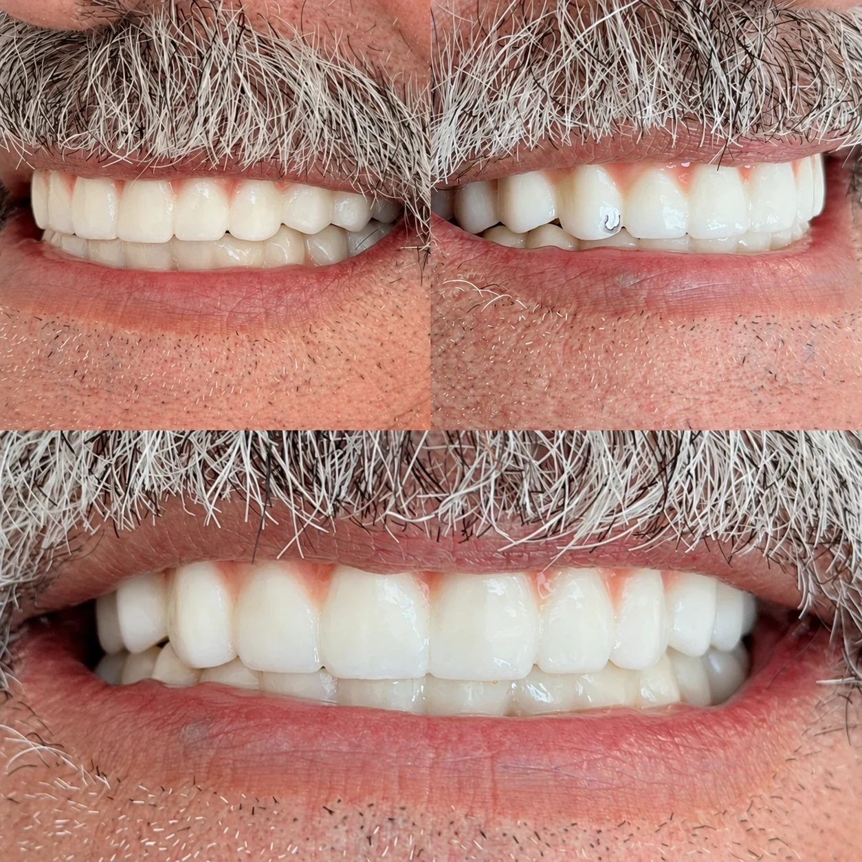 Three smile views showing the teeth beneath a grey moustache