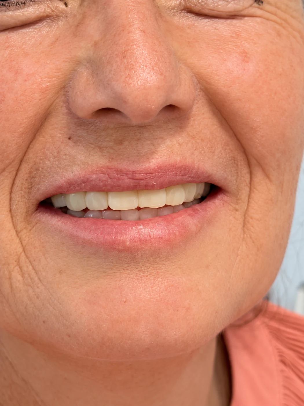 Close-up of an All-on-6 patient smile after treatment