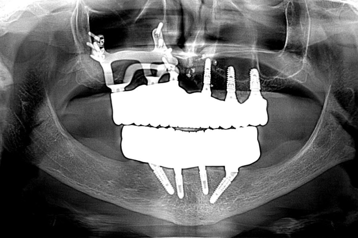 Panoramic X-ray of a subperiosteal implant framework supporting a full-arch restoration